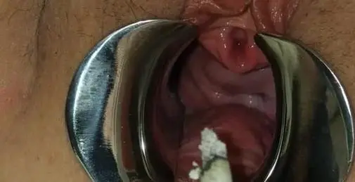 Peehole香烟折磨 性虐待窥镜拉伸女性尿道探测